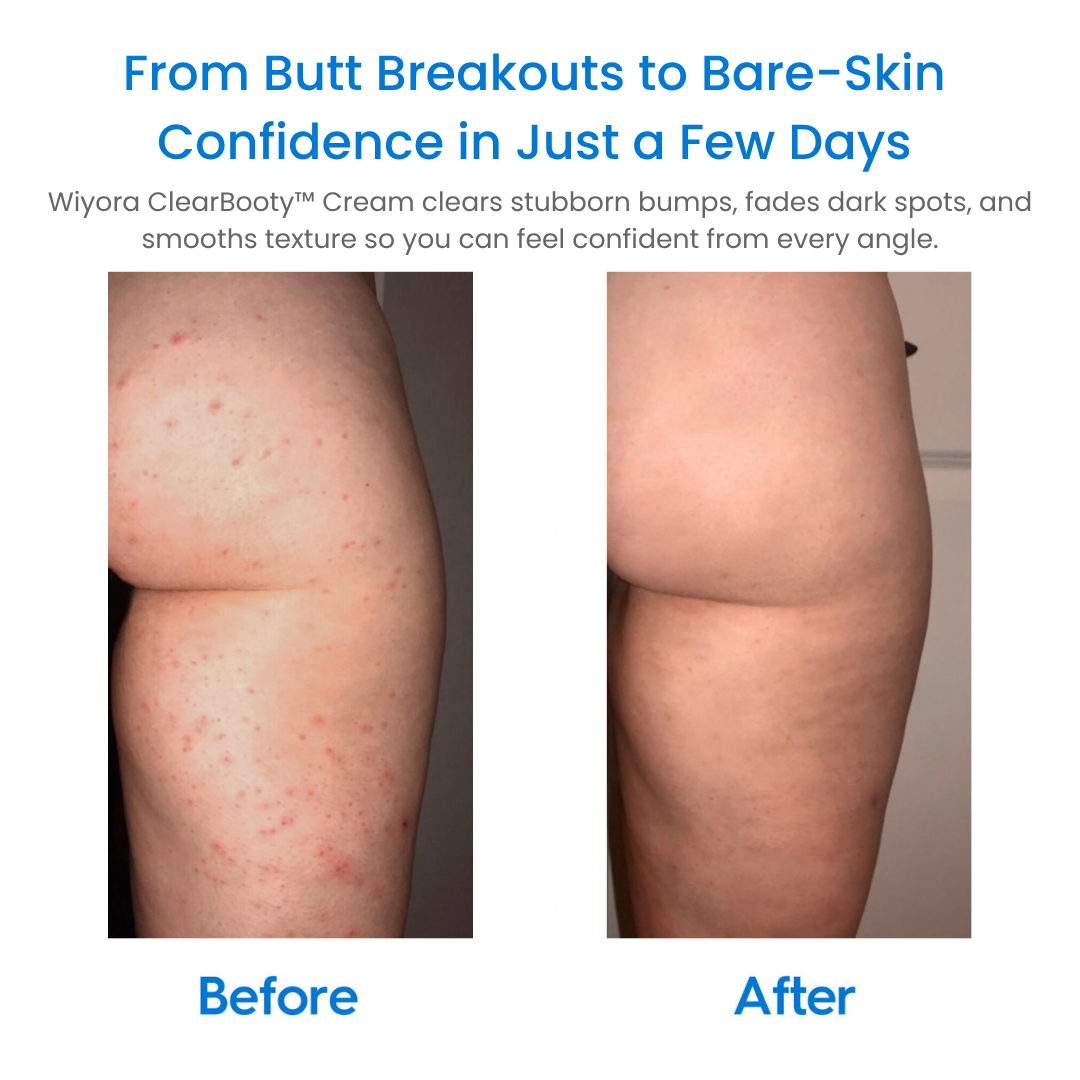 WIYORA ClearBooty™ Cream